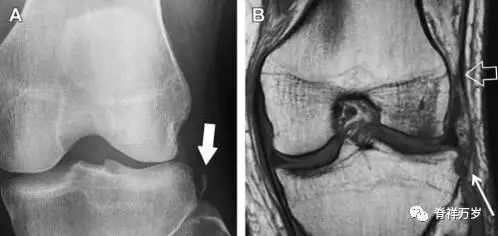 肩关节脱位易漏诊的骨折,放射科容易漏诊的骨折