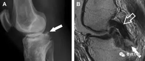 肩关节脱位易漏诊的骨折,放射科容易漏诊的骨折