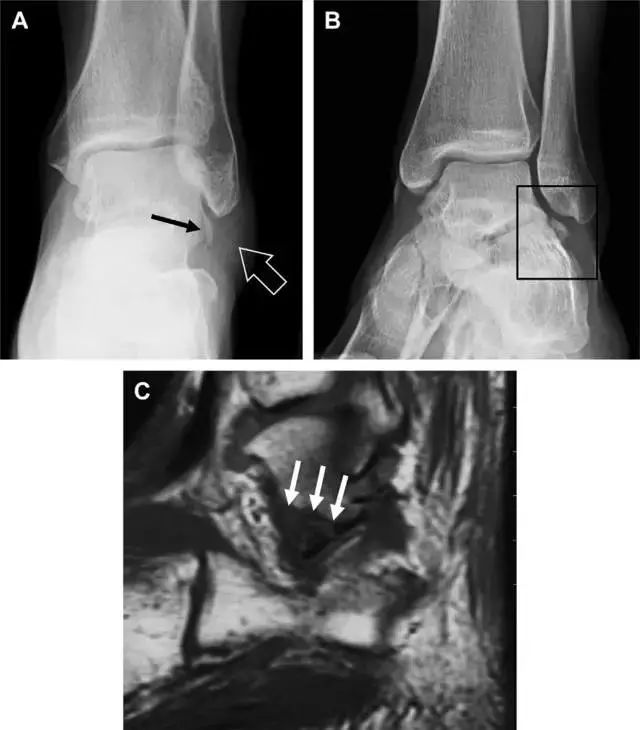肩关节脱位易漏诊的骨折,放射科容易漏诊的骨折