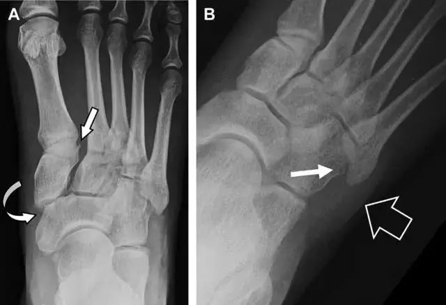 肩关节脱位易漏诊的骨折,放射科容易漏诊的骨折