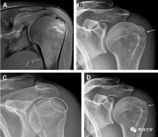 肩关节脱位易漏诊的骨折,放射科容易漏诊的骨折