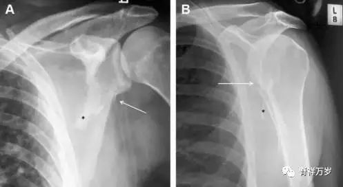 肩关节脱位易漏诊的骨折,放射科容易漏诊的骨折