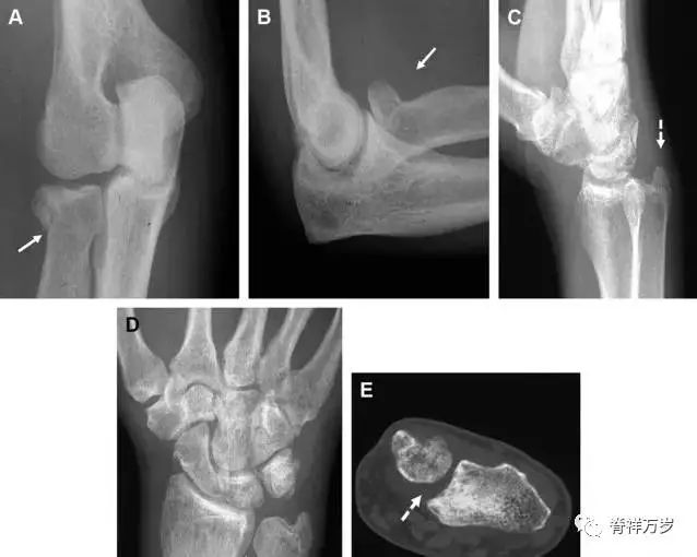 肩关节脱位易漏诊的骨折,放射科容易漏诊的骨折