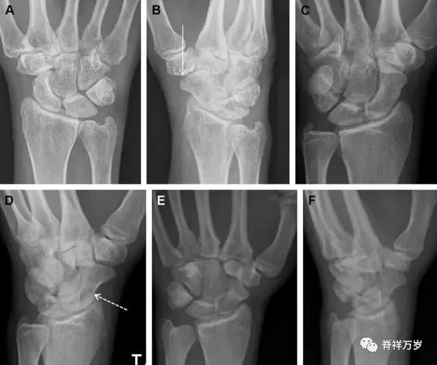 肩关节脱位易漏诊的骨折,放射科容易漏诊的骨折