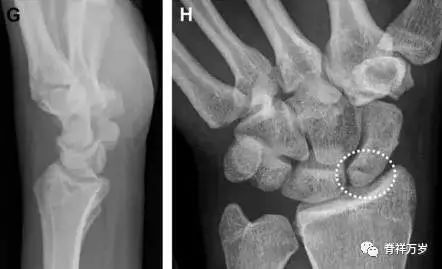 肩关节脱位易漏诊的骨折,放射科容易漏诊的骨折
