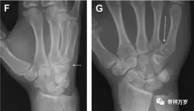 肩关节脱位易漏诊的骨折,放射科容易漏诊的骨折