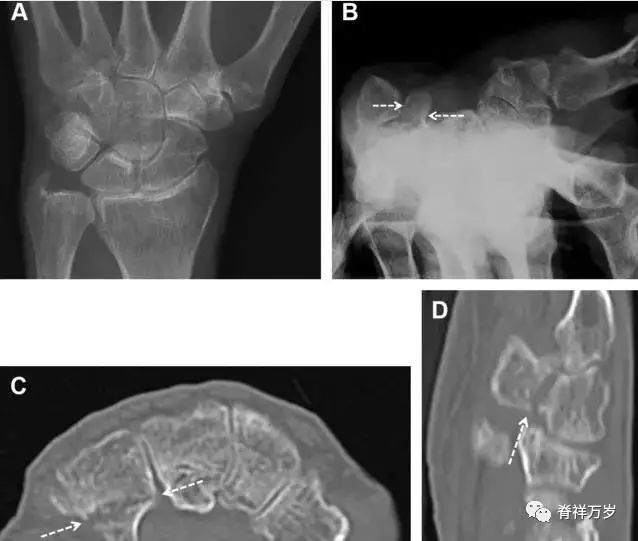 肩关节脱位易漏诊的骨折,放射科容易漏诊的骨折