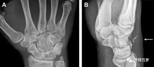 肩关节脱位易漏诊的骨折,放射科容易漏诊的骨折