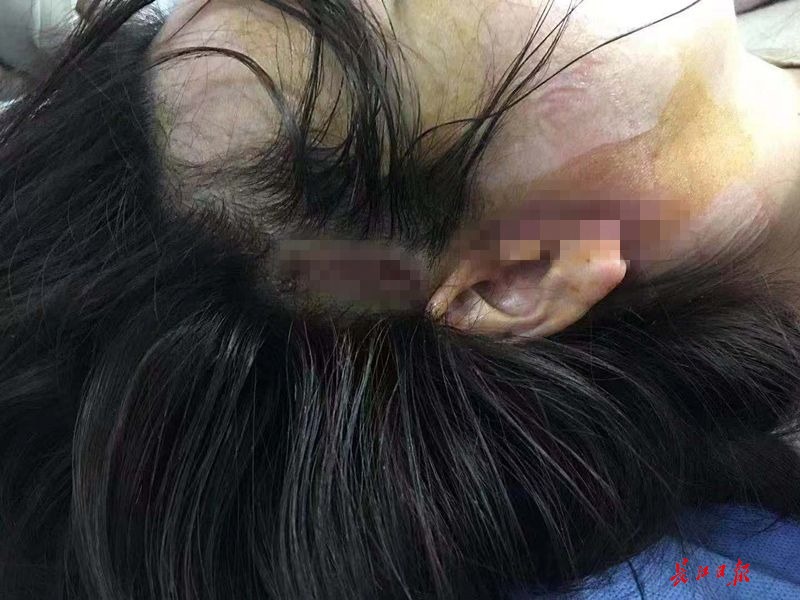 女子拉皮后额头皮肤坏死,拉皮手术后面部瘀血严重