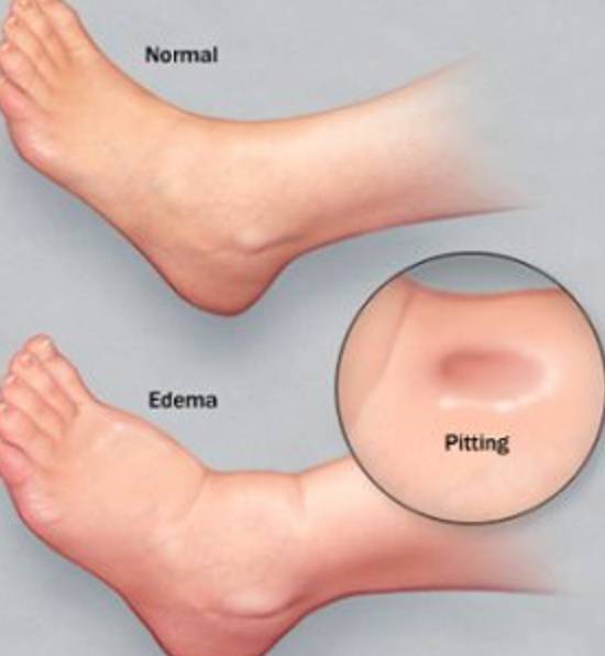 身体出现水肿去医院检查哪个科,老年人下肢水肿需要看哪个科