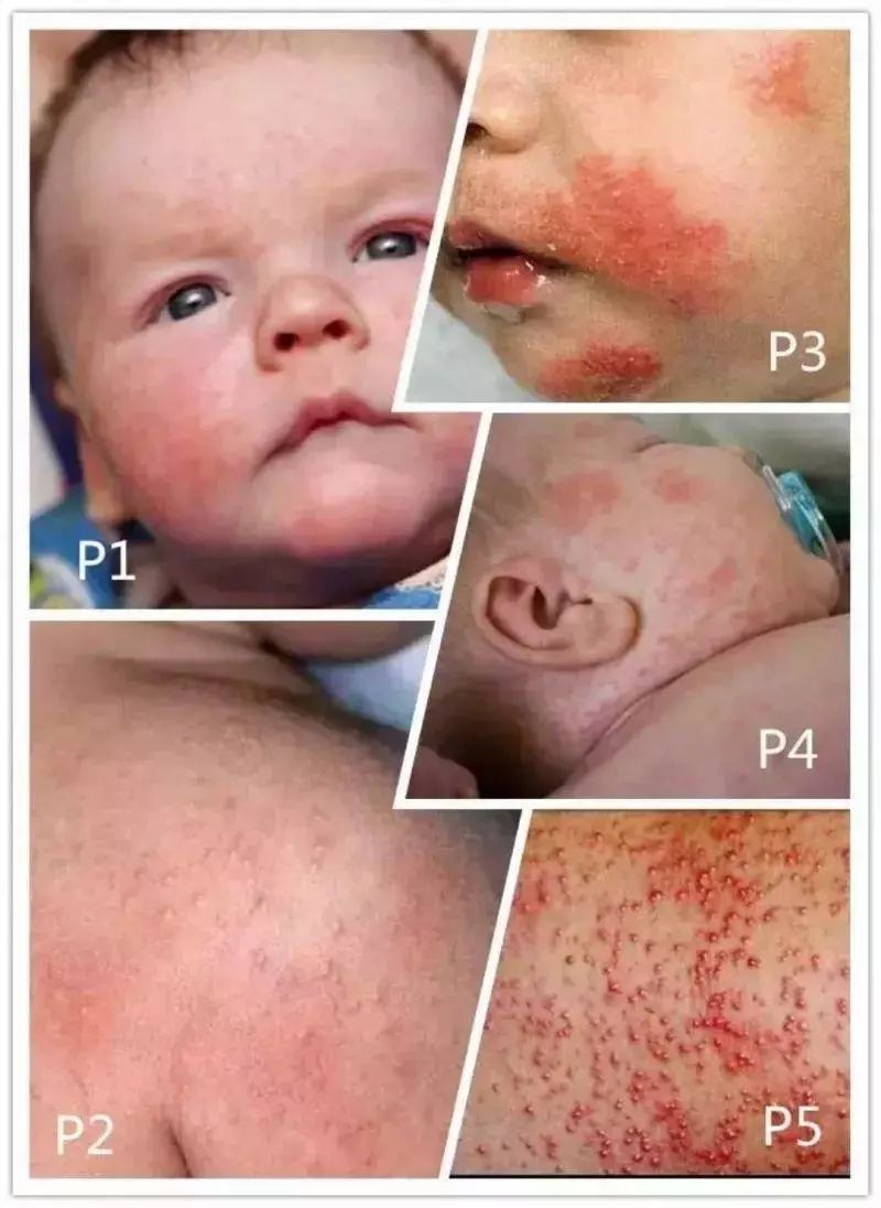 泰国治癣的药膏排行榜,泰国治疗皮肤癣的药膏