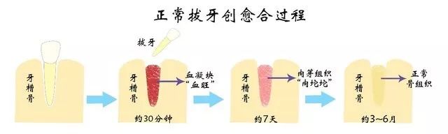 拔牙后能吃东西了吗,拔牙以后能吃能洗澡吗