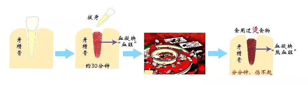拔牙后能吃东西了吗,拔牙以后能吃能洗澡吗