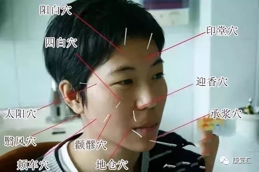 康复科治疗面瘫效果怎么样,面瘫康复训练评分