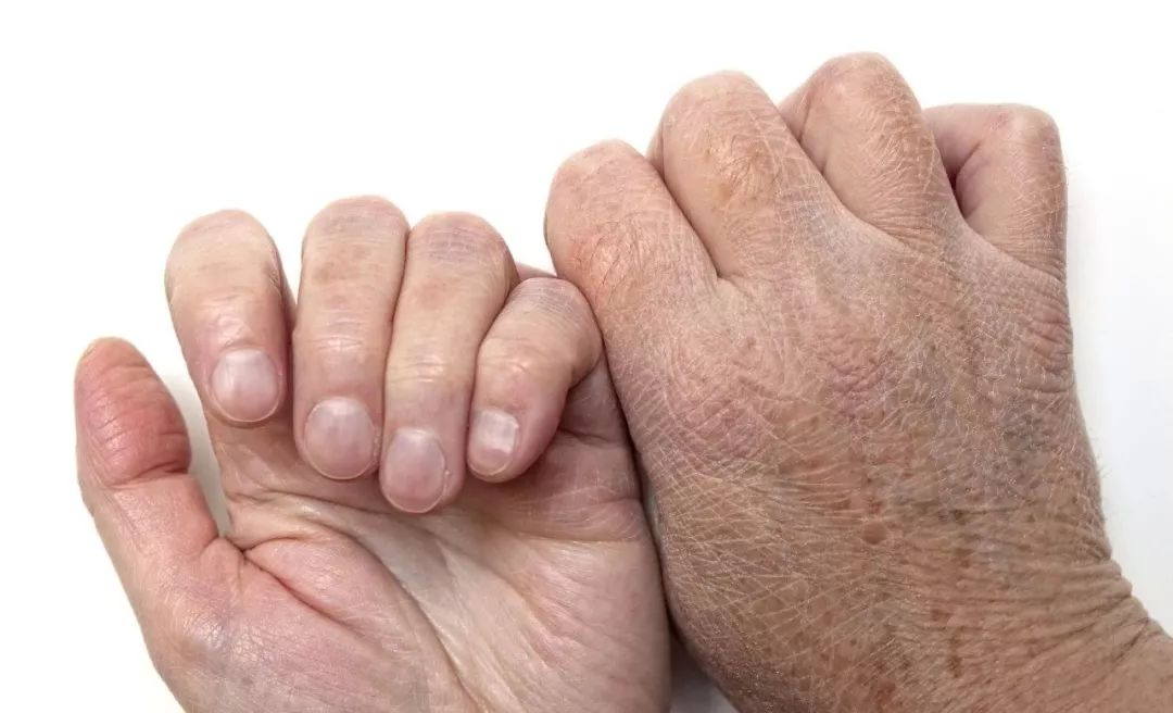 冬季皮肤干燥起皮用什么护肤,冬季脸上皮肤干燥起皮刺痛怎么办