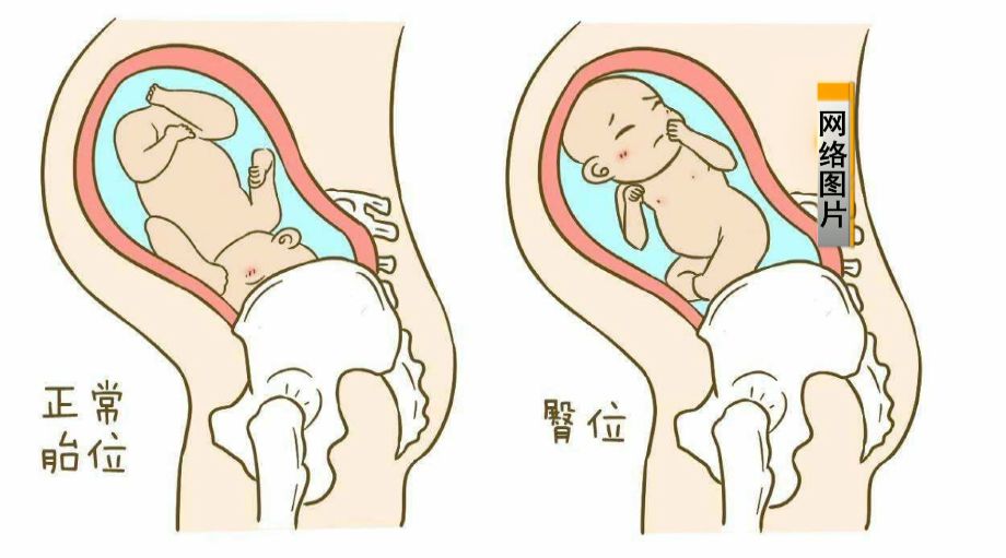 孕妇9个月在做瑜伽突然羊水破了,孕期练瑜伽危险吗