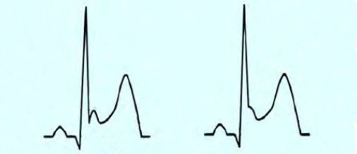小伙说心电图有异常手术中有问题,小伙去医院检查后有什么毛病