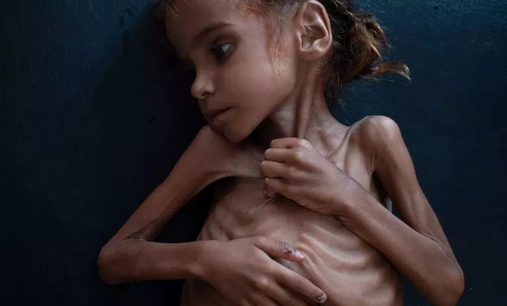 普利策奖饥饿的小孩,饥饿女孩