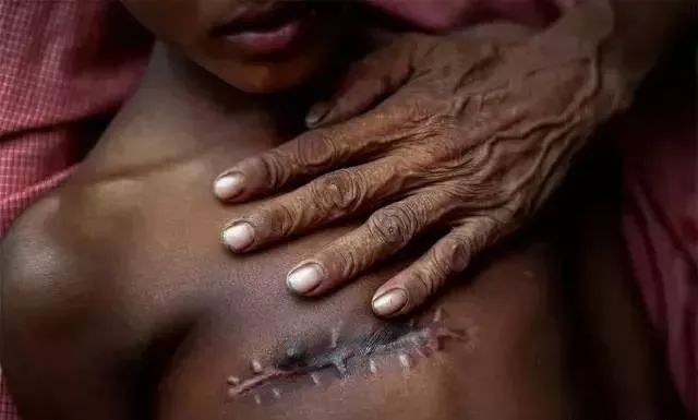 普利策奖饥饿的小孩,饥饿女孩