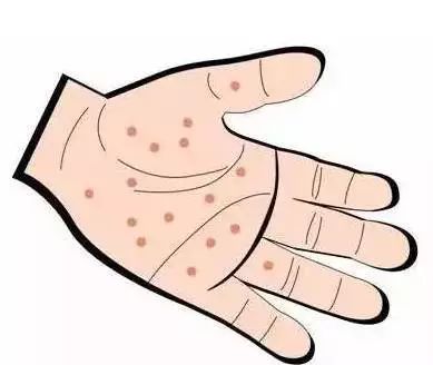 涓尰鎵嬫寚闀挎按娉$棐,涓尰杈ㄨ瘉鎵嬩笂闀垮皬姘存场寰堢棐