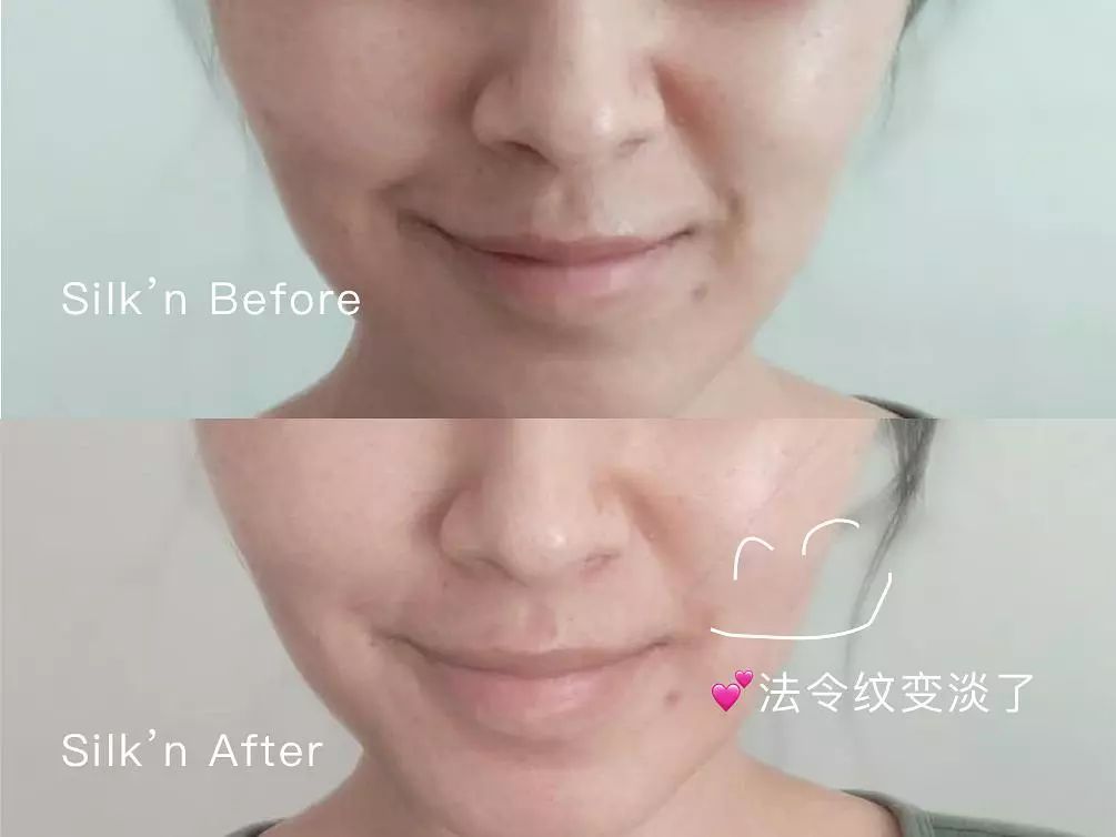 敏感肌哪一款美容仪是最好的,改善肤质选哪款美容仪