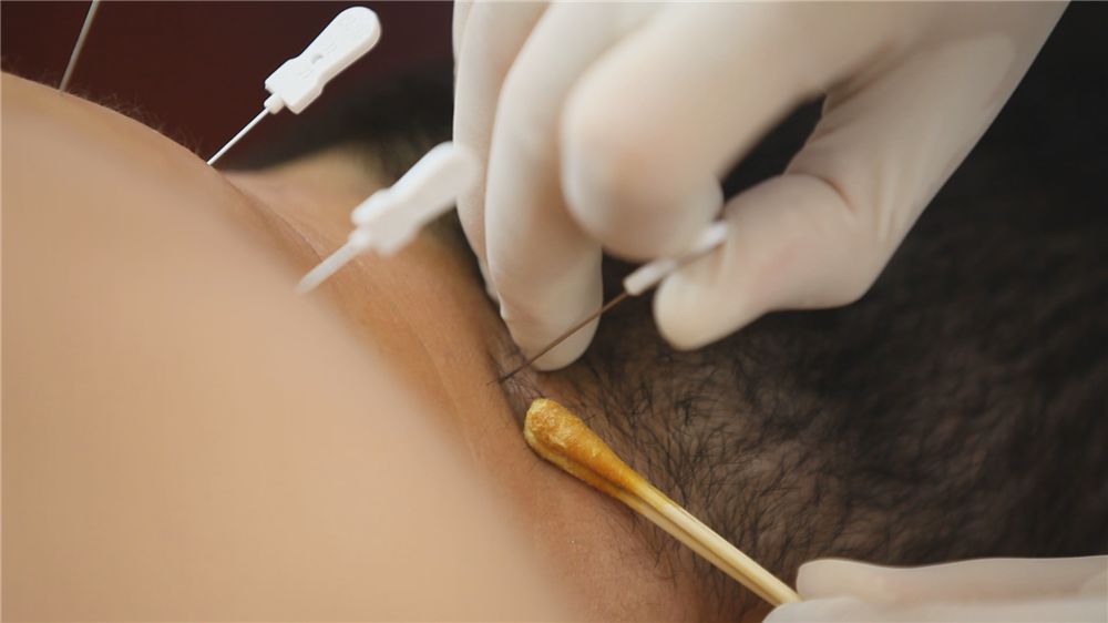 神奇的小针刀图片,神奇的小针刀是万能的吗