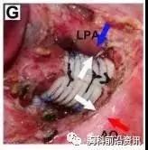 唐都医院4D打印气管外支架成功救治气管软化症患儿