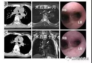 唐都医院4D打印气管外支架成功救治气管软化症患儿