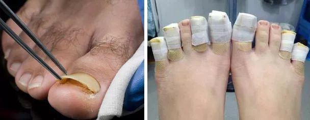 灰指甲的治愈之路你值得拥有,10年顽固灰指甲久治不愈