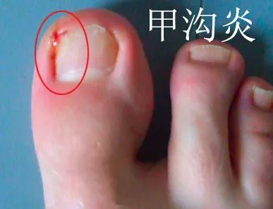 灰指甲的治愈之路你值得拥有,10年顽固灰指甲久治不愈