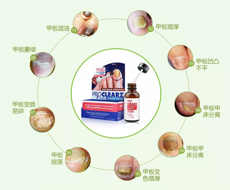 灰指甲的治愈之路你值得拥有,10年顽固灰指甲久治不愈