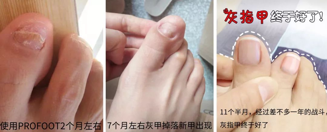 灰指甲的治愈之路你值得拥有,10年顽固灰指甲久治不愈