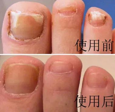 灰指甲的治愈之路你值得拥有,10年顽固灰指甲久治不愈