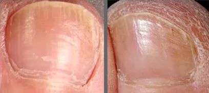 灰指甲的治愈之路你值得拥有,10年顽固灰指甲久治不愈