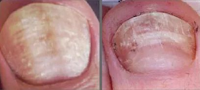 灰指甲的治愈之路你值得拥有,10年顽固灰指甲久治不愈