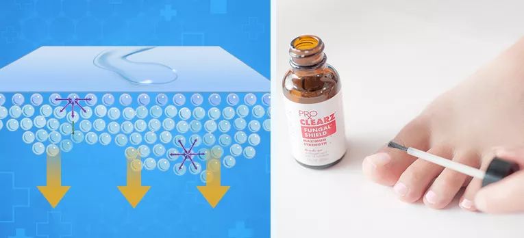 灰指甲的治愈之路你值得拥有,10年顽固灰指甲久治不愈