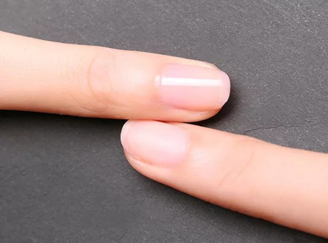 灰指甲的治愈之路你值得拥有,10年顽固灰指甲久治不愈