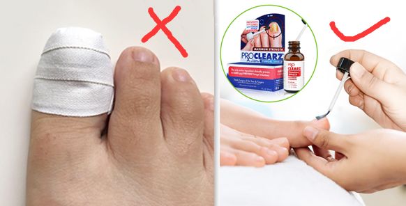 灰指甲的治愈之路你值得拥有,10年顽固灰指甲久治不愈