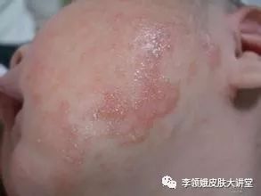 「杏林微科普」湿疹，我该拿你怎么办？——防护治疗篇