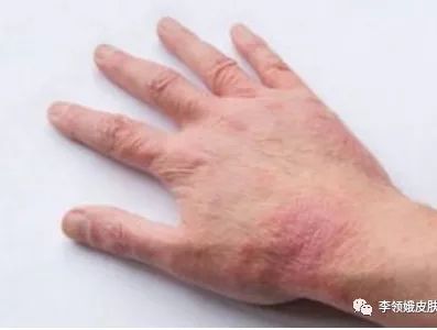 「杏林微科普」湿疹，我该拿你怎么办？——防护治疗篇