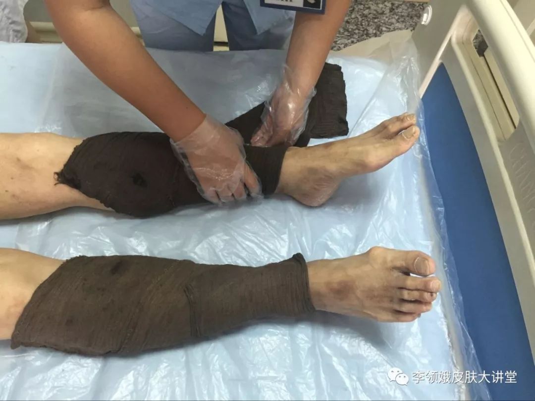 「杏林微科普」湿疹，我该拿你怎么办？——防护治疗篇