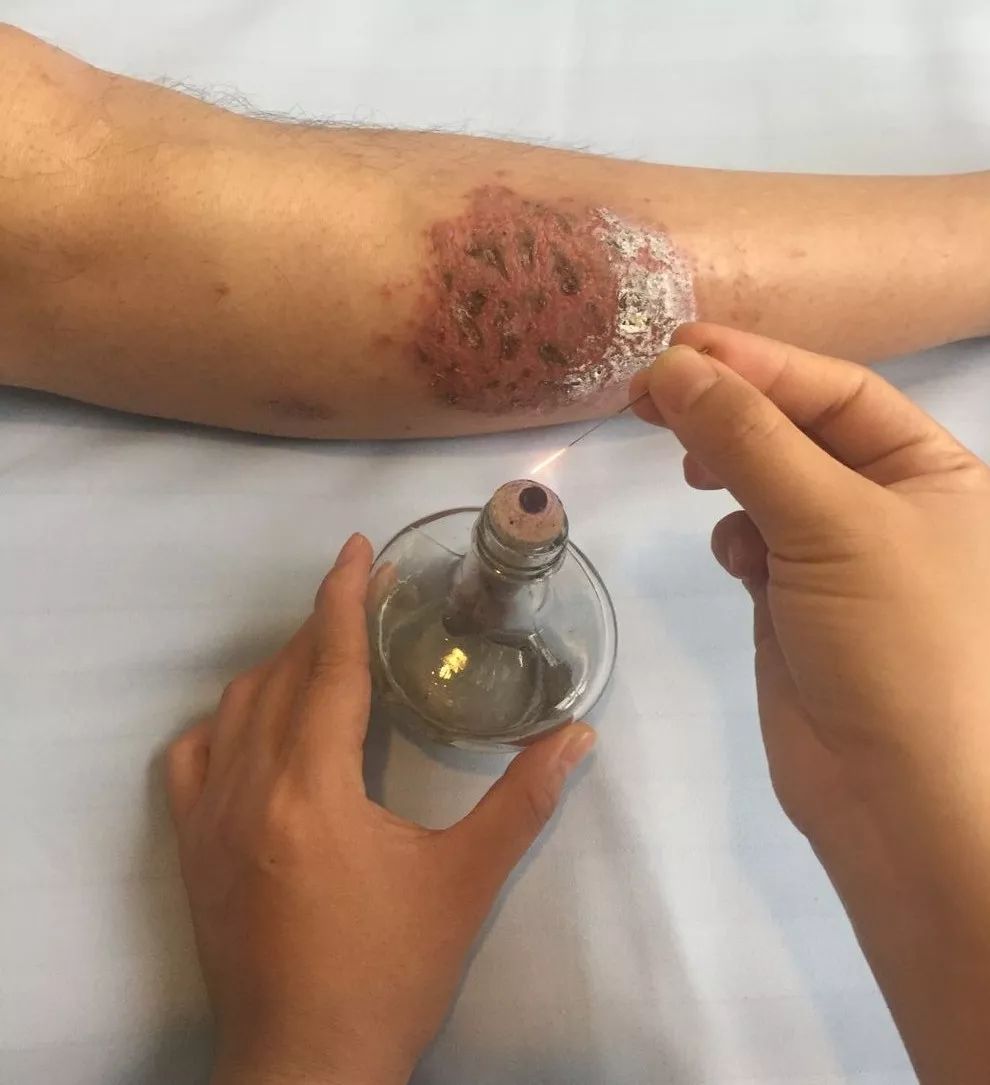 「杏林微科普」湿疹，我该拿你怎么办？——防护治疗篇