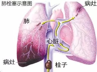 呼吸困难是什么原因,呼吸困难吃什么药