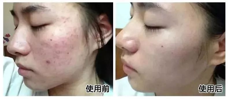 人脸上螨虫的数量,人脸上有多少螨虫