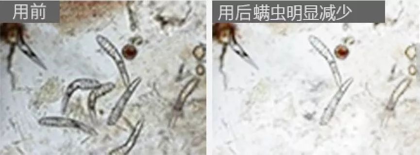 人脸上螨虫的数量,人脸上有多少螨虫