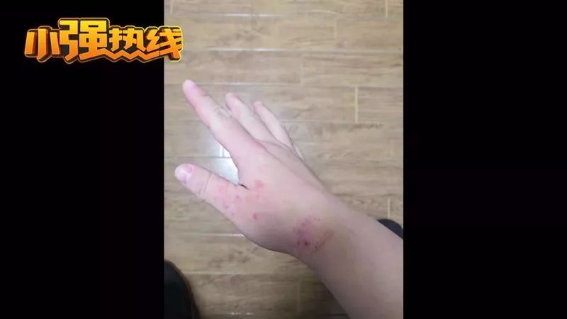 湿疹孩子成功治愈案例,女儿湿疹终于好了