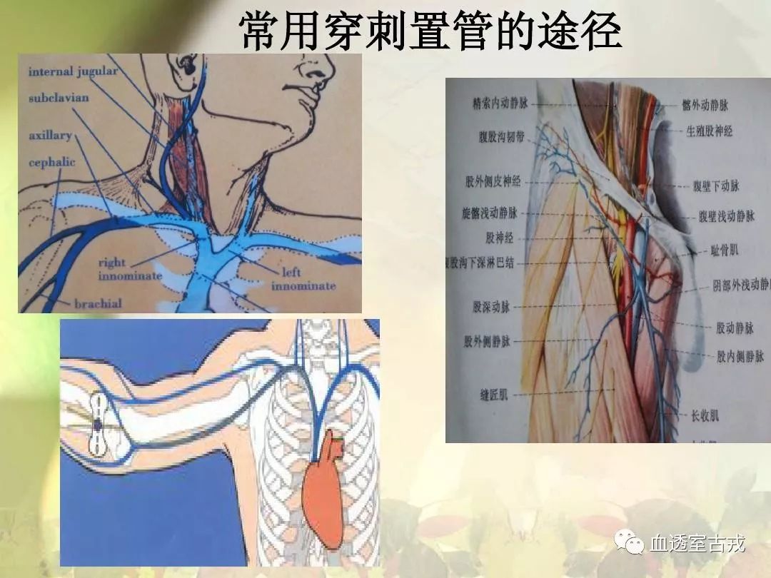 中心静脉导管使用方法视频,中心静脉导管护理技术操作标准