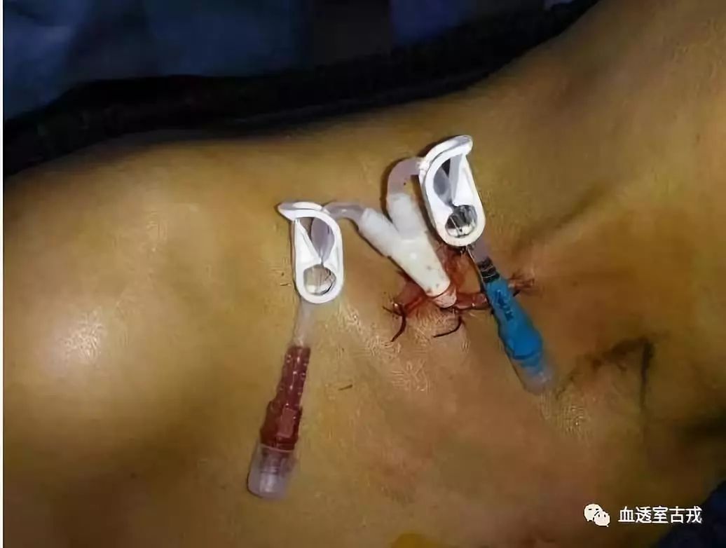 中心静脉导管使用方法视频,中心静脉导管护理技术操作标准