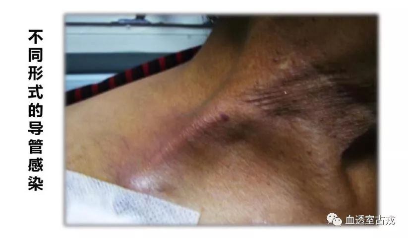 中心静脉导管使用方法视频,中心静脉导管护理技术操作标准