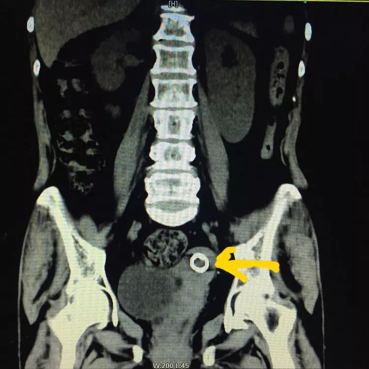 宫内节育器y型,渭北宫内节育器